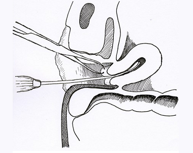 Kyretáž dělohy - revize dutiny děložní 