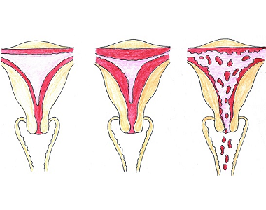 Opožděná menstruace, zpoždění menstruace